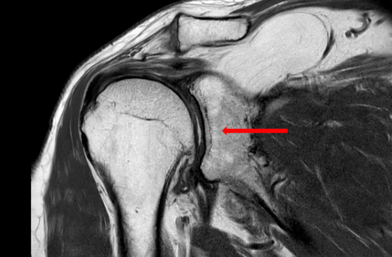 MRI scan van het schoudergewricht
