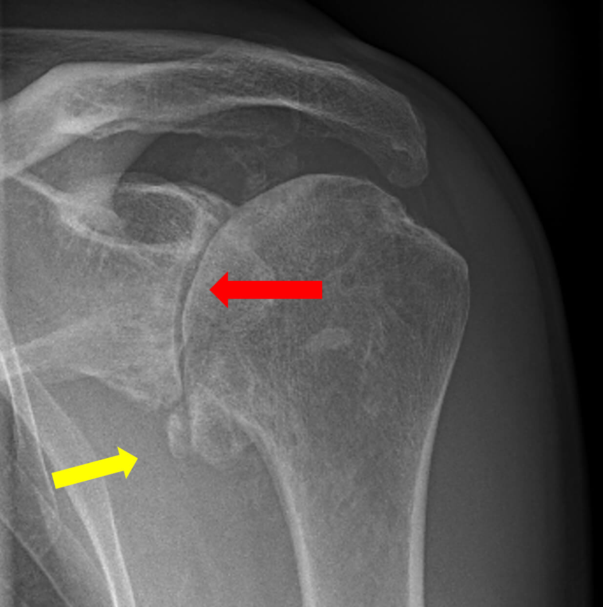 Röntgenfoto van het schoudergewricht