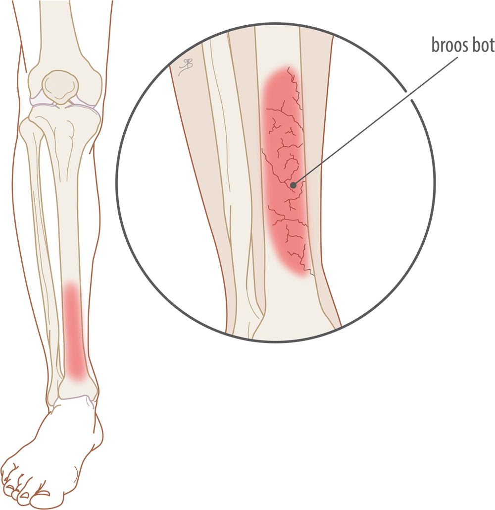 Wat is er aan de hand bij shin splints?