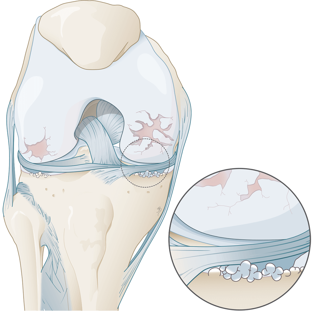 Wat is er aan de hand bij artrose van de knie?