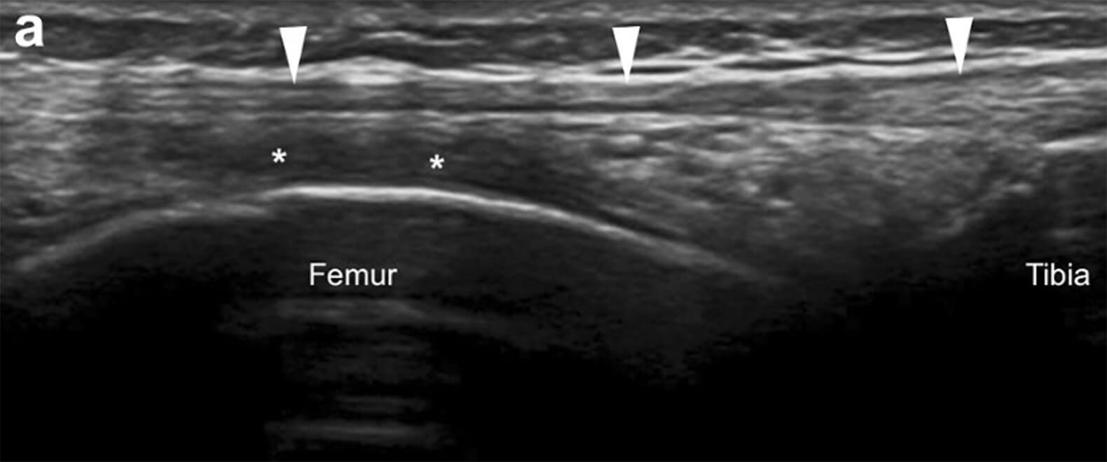 Echografie bij een lopersknie
