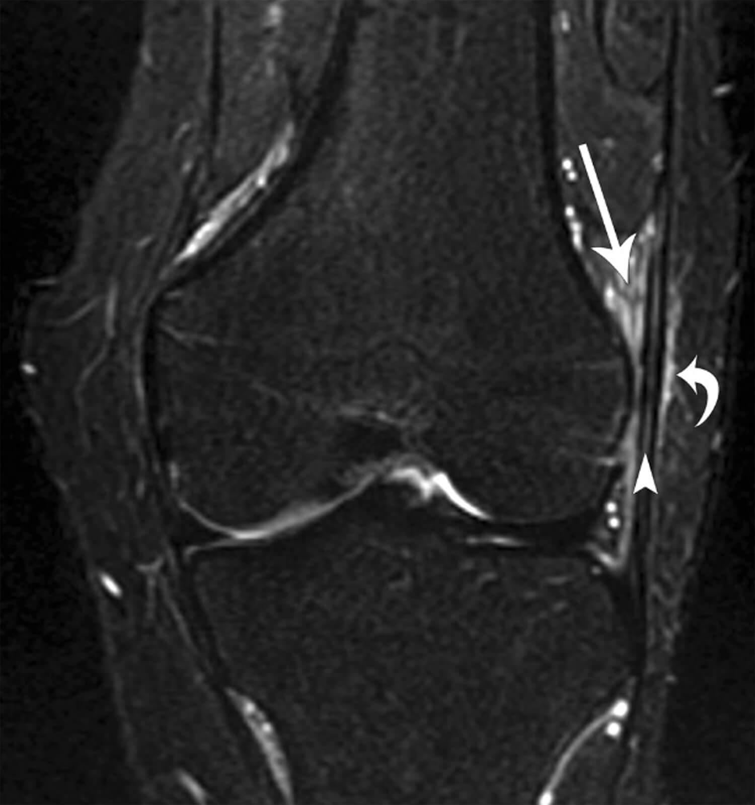 MRI scan bij een lopersknie