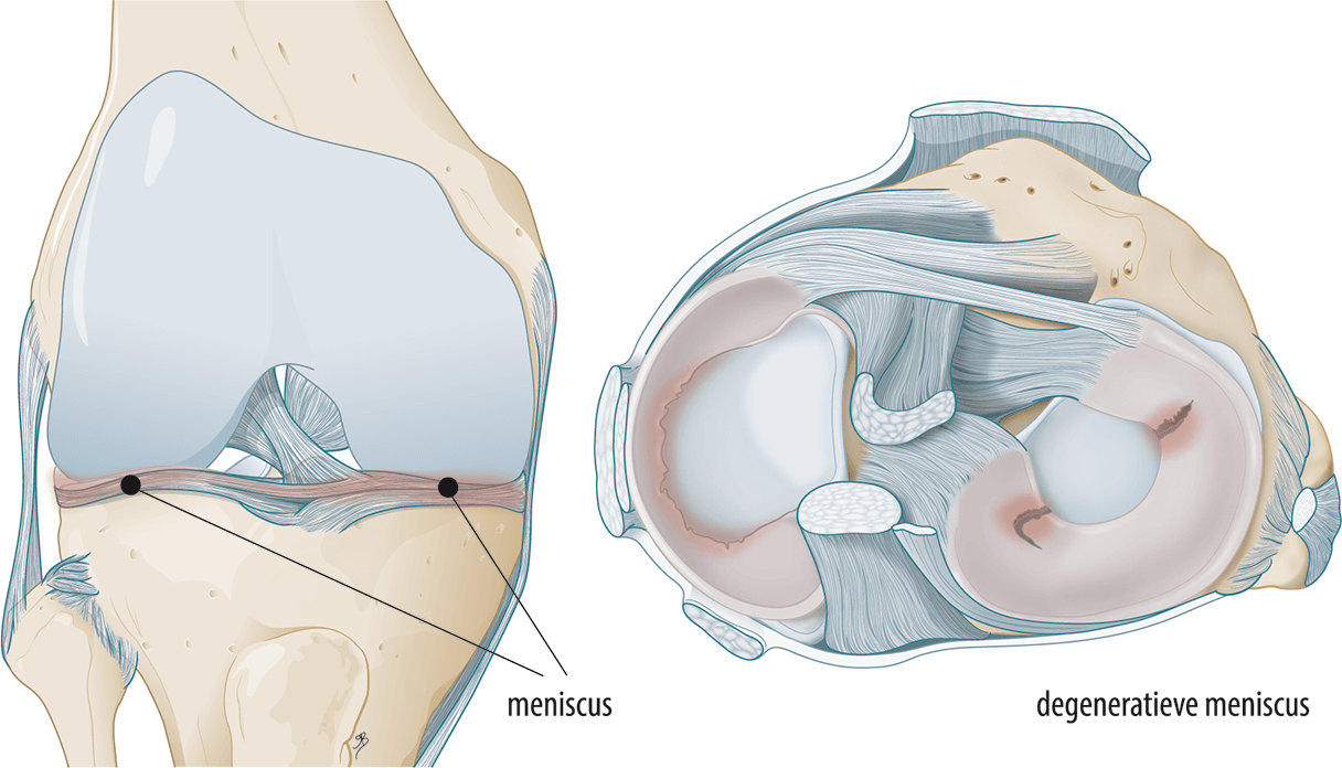 Verminderde kwaliteit van de meniscus (knie)