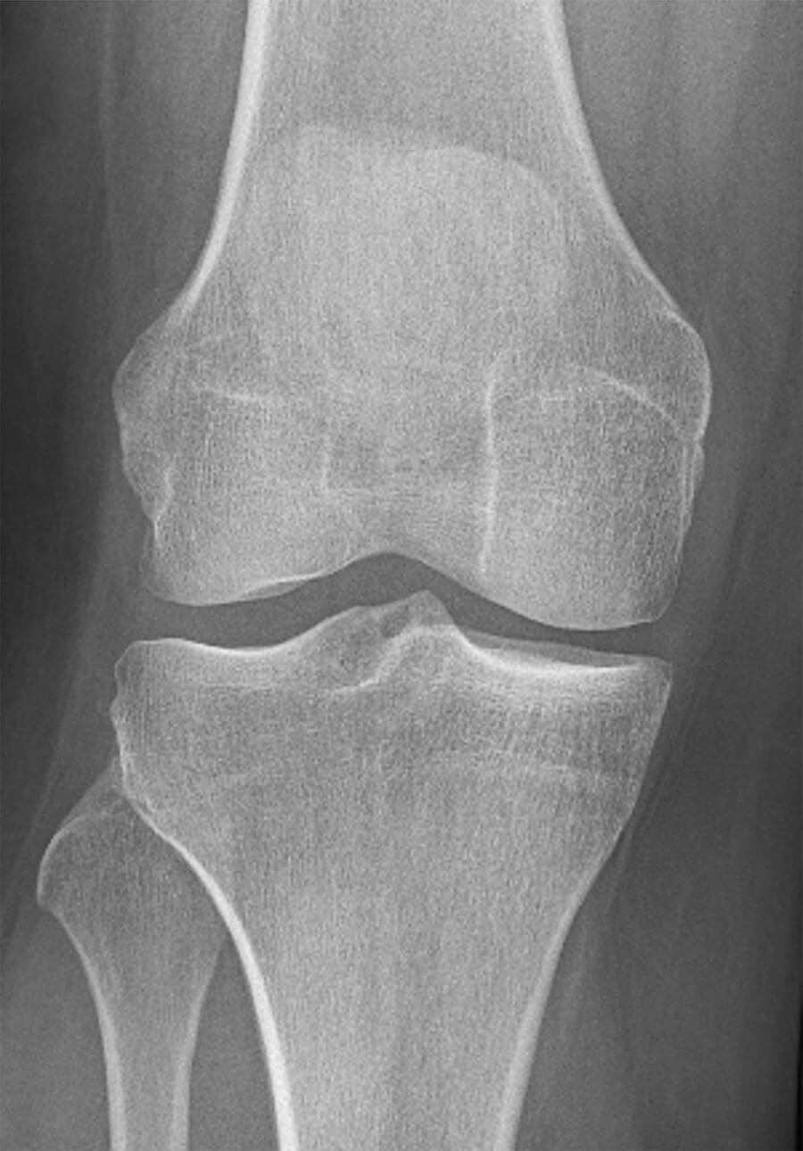 Röntgenfoto bij verminderde kwaliteit van de meniscus