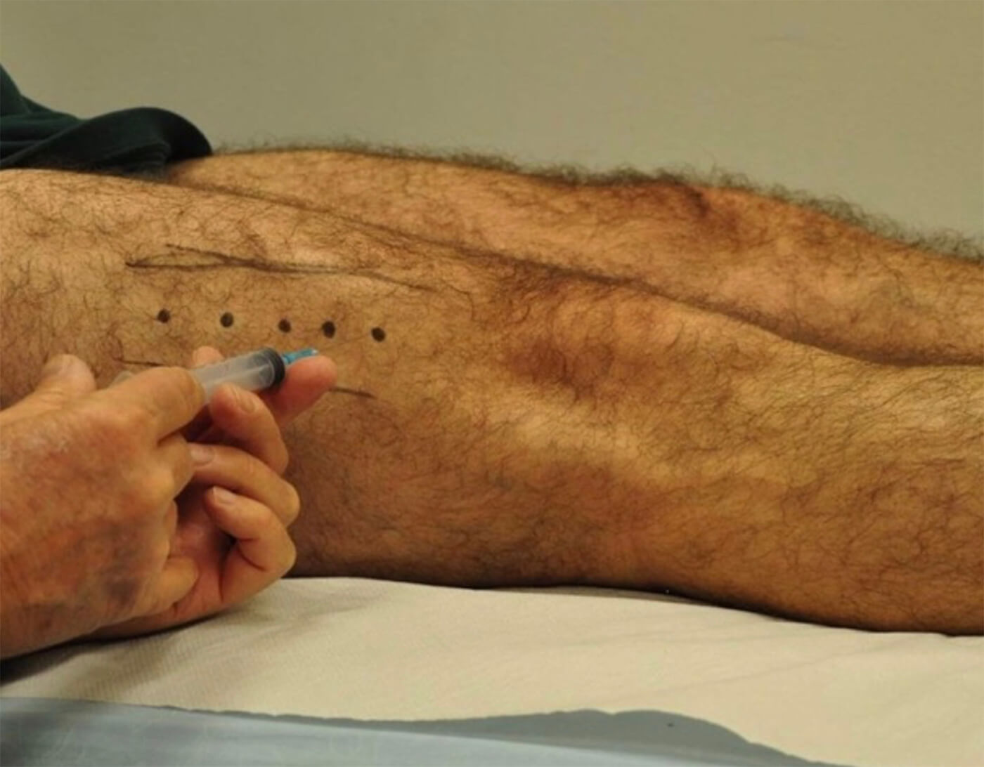 Injecties met botox bij het patellofemoraal pijnsyndroom