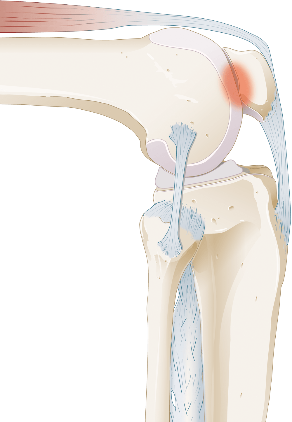 Wat is er aan de hand bij klachten van het patellofemoraal pijnsyndroom (PFPS)?