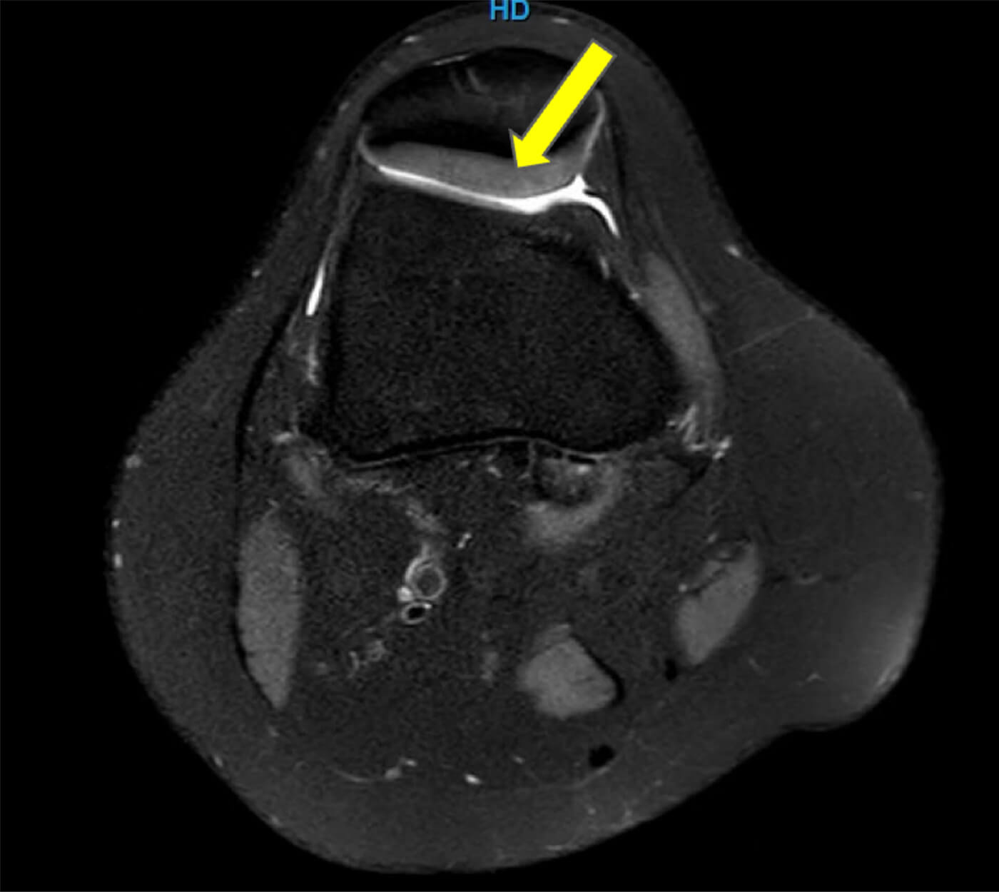 MRI-scan met bovenaanzicht van de knie