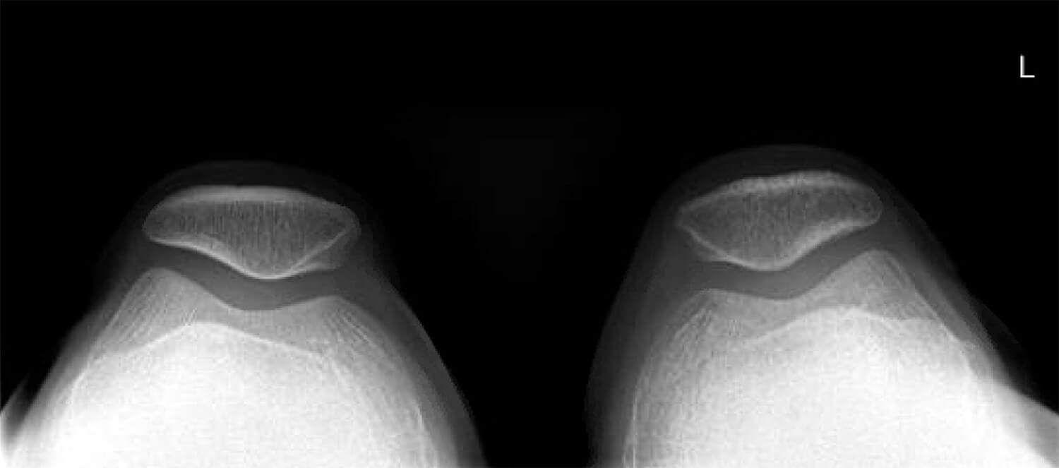 Een röntgenfoto van de bovenzijde genomen