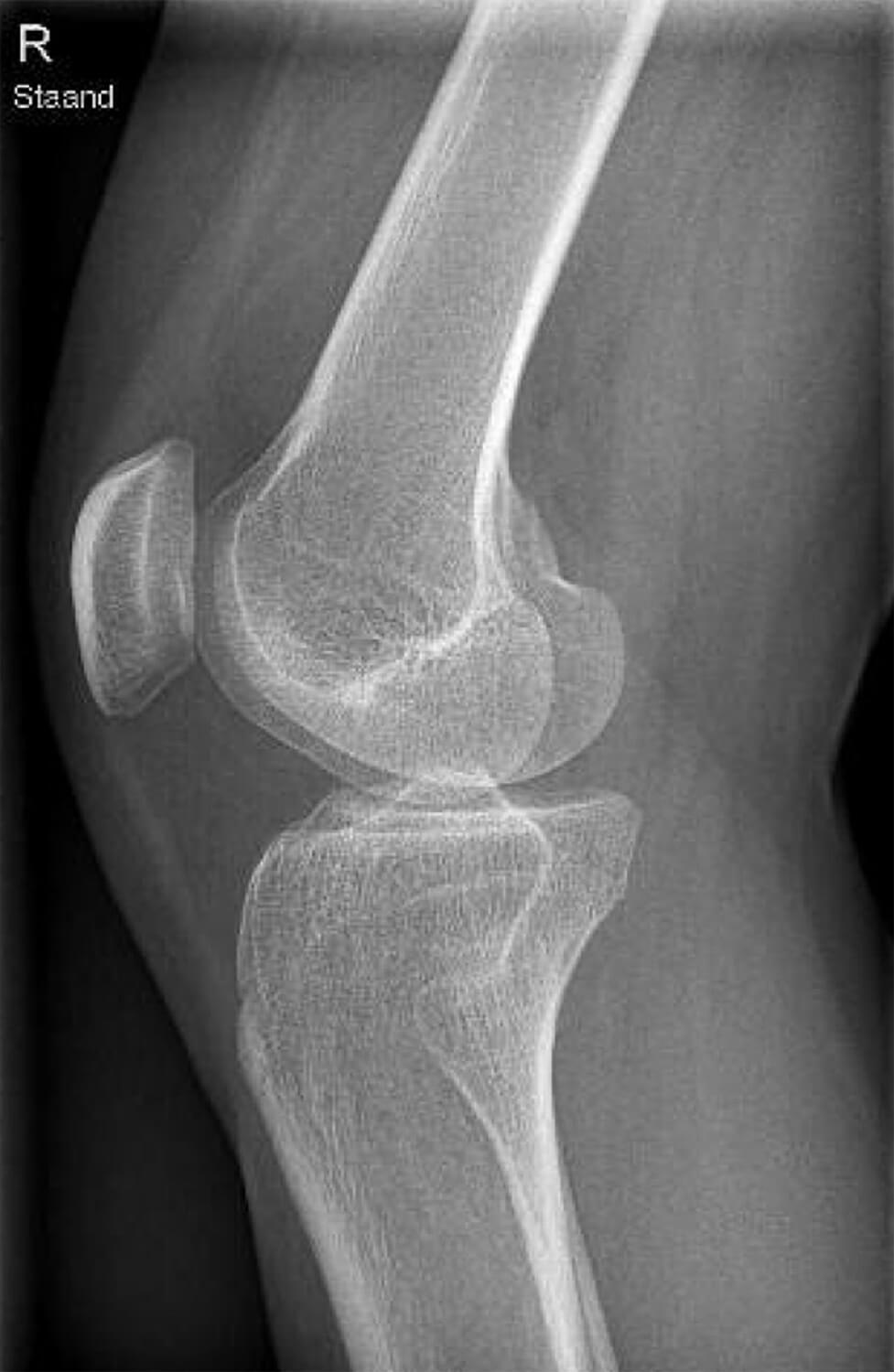 Een röntgenfoto van de zijkant genomen