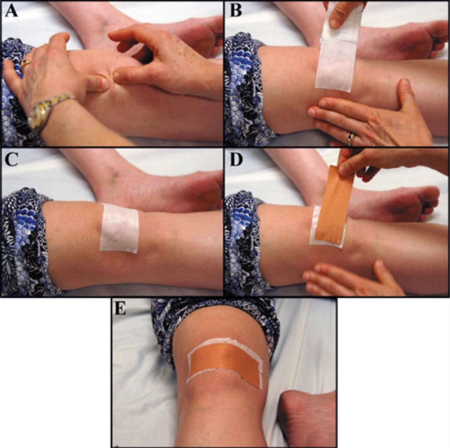 Tapen kan de knieschijf bij het patellofemoraal pijnsyndroom