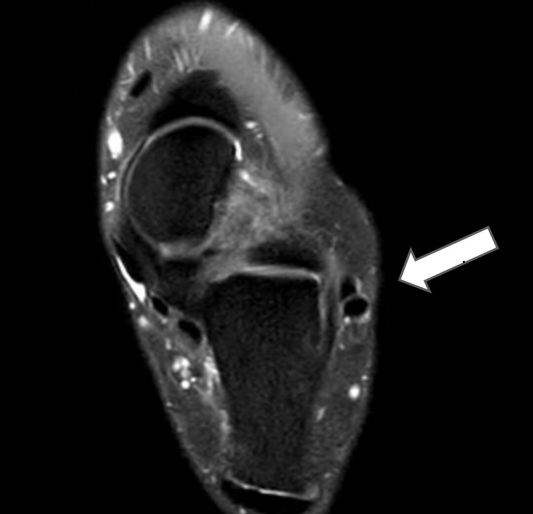 MRI scan bij klachten van de peroneuspezen