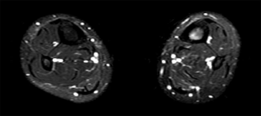MRI bij klassieke klachten van shin splints