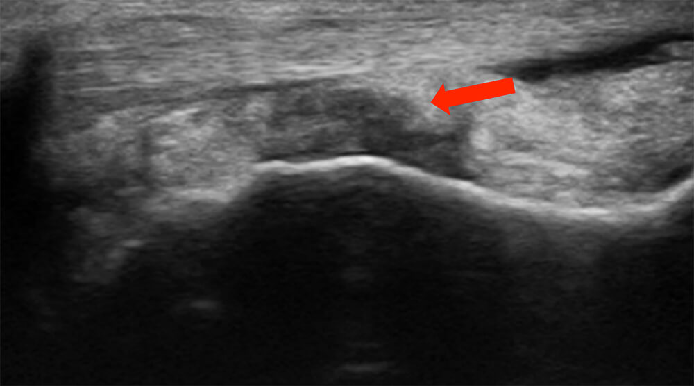 Echografie bij klachten van de tibialis anterior pees