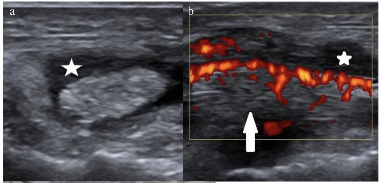 Echografie van de tibialis posterior pees Echografie met vocht rond de tibialis posterior pees en nieuw ingegroeide bloedvaatjes