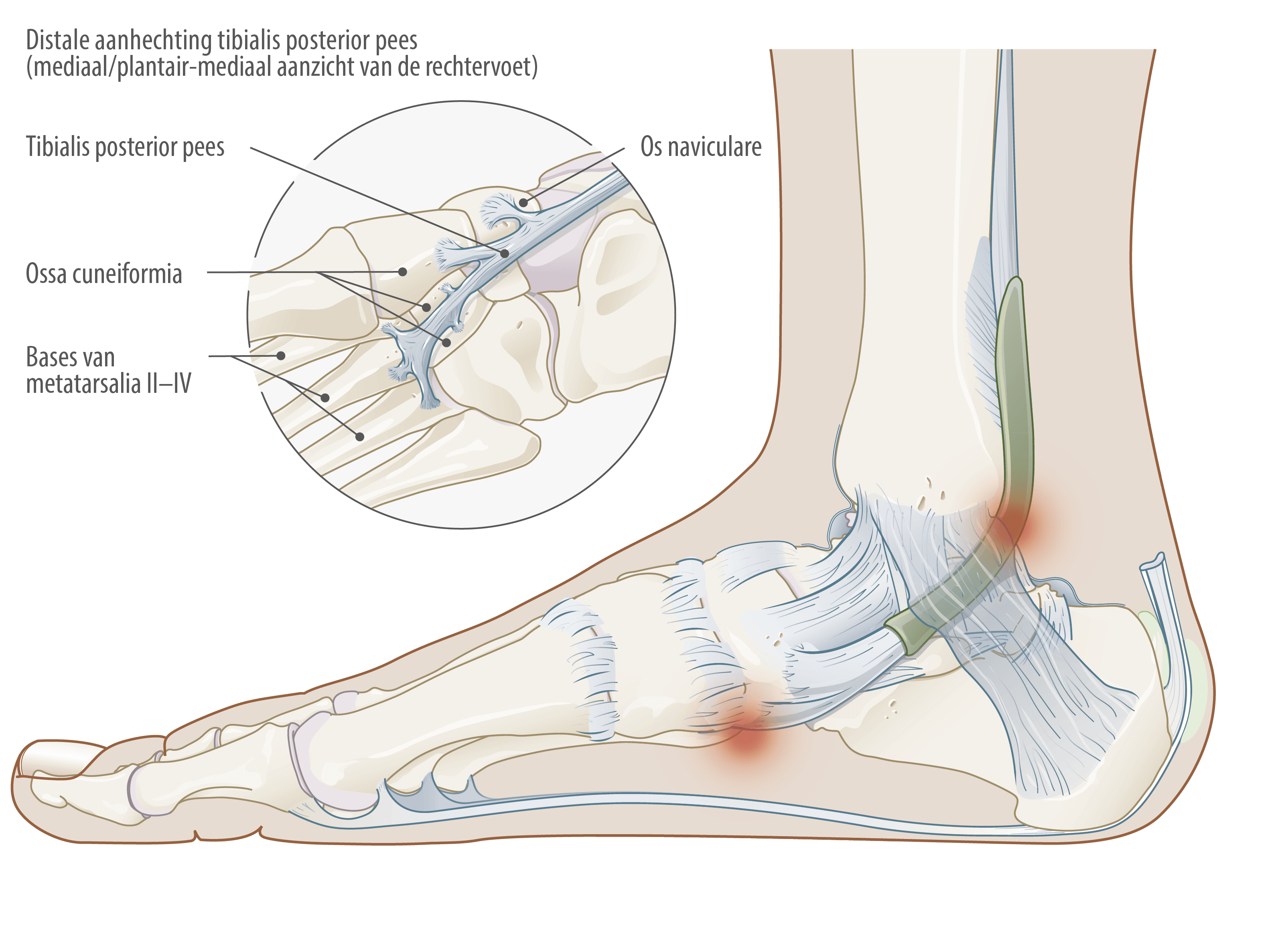 Klachten van de tibialis posterior pees aan de binnenzijde van de enkel en voet Illustratie van het verloop en de aanhechtingen van de tibialis posterior pees aan de binnenzijde van de rechtervoet
