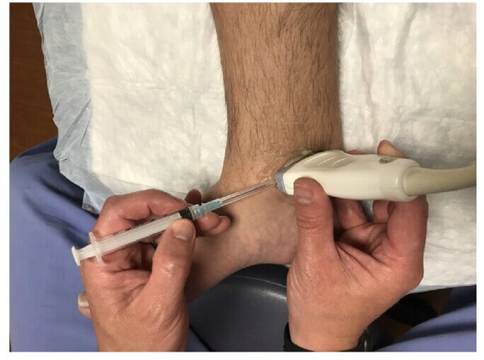 Echogeleide injectie rond de tibialis posterior pees Procedure van een echogeleide injectie met corticosteroïden rond de tibialis posterior pees