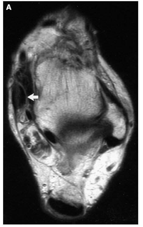 MRI-scan van de tibialis posterior pees MRI-scan van de enkel met een verdikte tibialis posterior pees