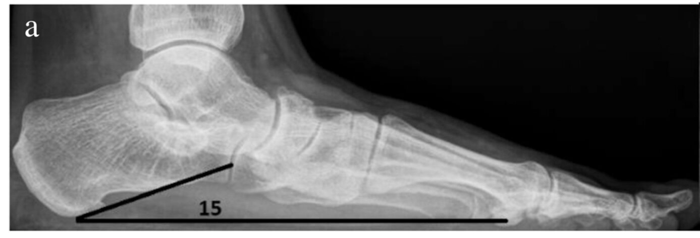 Röntgenfoto bij klachten van de tibialis posterior pees Röntgenfoto waarop de mate van inzakking van de voetboog wordt gemeten