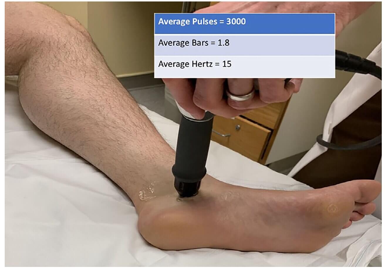 Shockwavetherapie voor de tibialis posterior pees Voorbeeld van shockwavetherapie bij klachten van de tibialis posterior pees